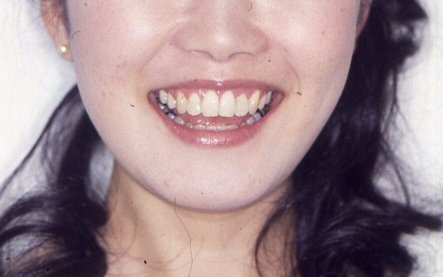 八重歯と輪郭を矯正治療で整えた後の笑顔
