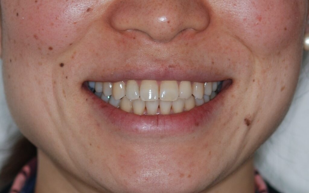 前歯の隙間を矯正治療で治した後