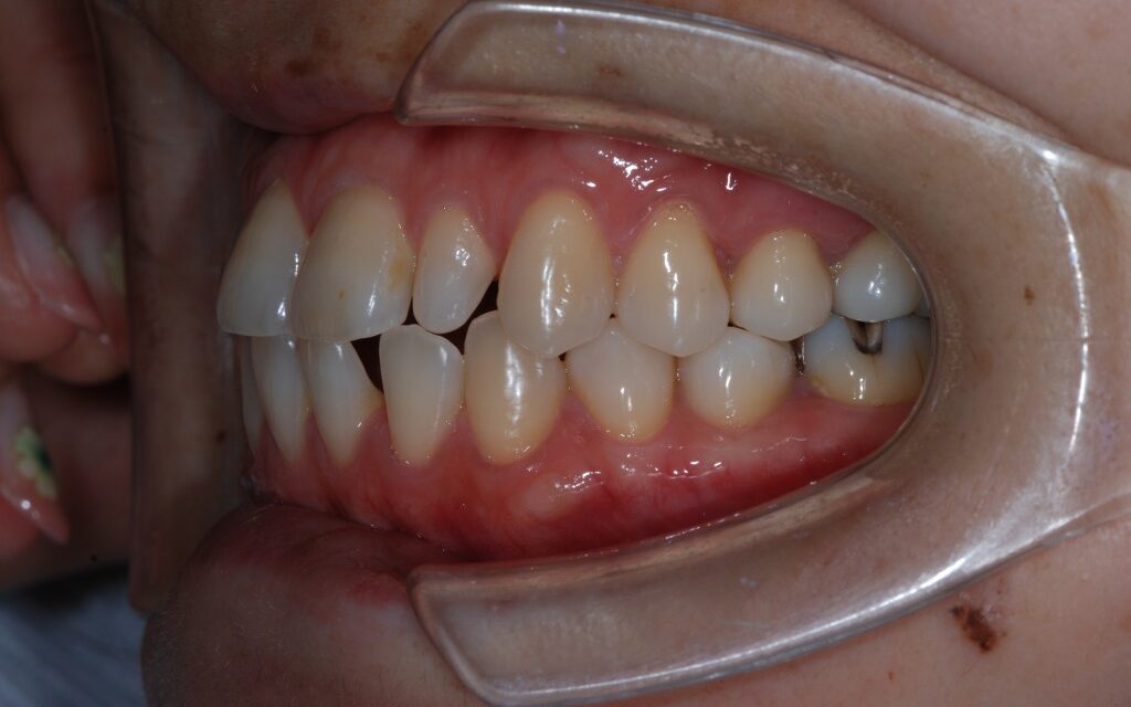 前歯の隙間を矯正治療で治す前