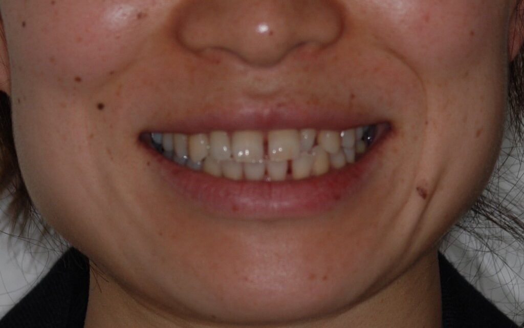 前歯の隙間を矯正治療で治す前