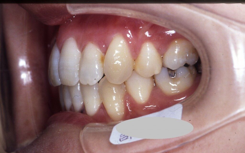 八重歯と輪郭を矯正治療で整えた後の歯並び
