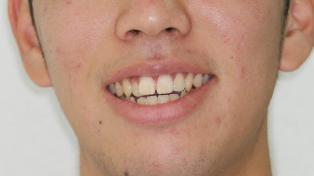 歯のでこぼこの部分矯正の矯正治療前