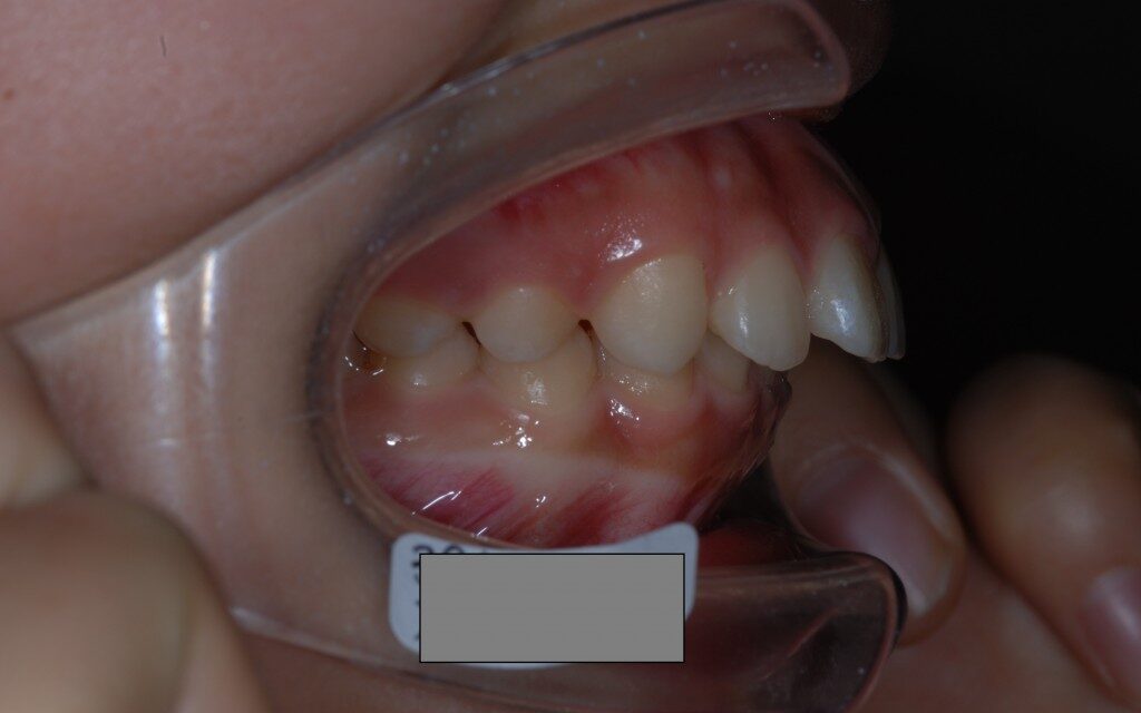 中学生高校生の出っ歯の矯正治療前