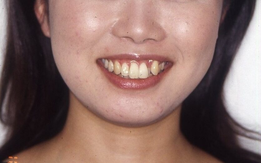 八重歯と輪郭を矯正治療で整える前の笑顔