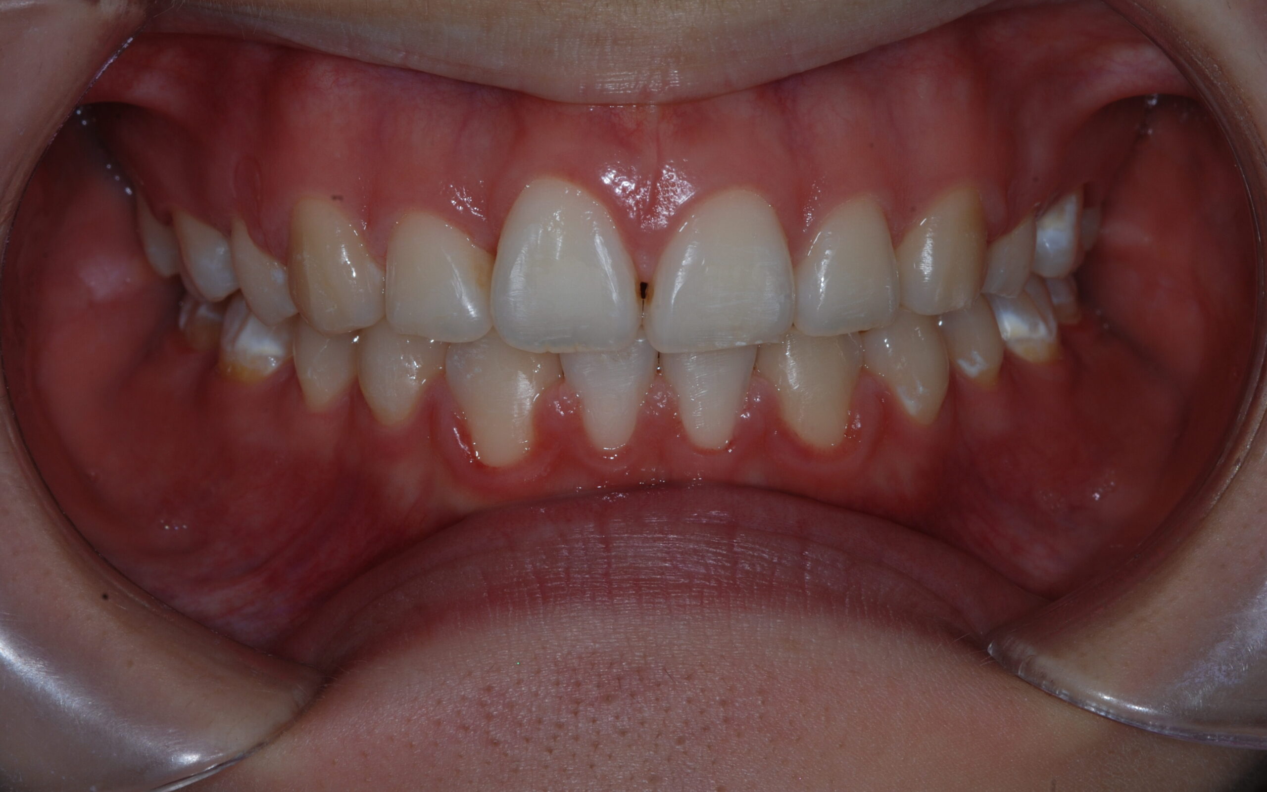 歯の隙間を矯正治療で閉じた治療例