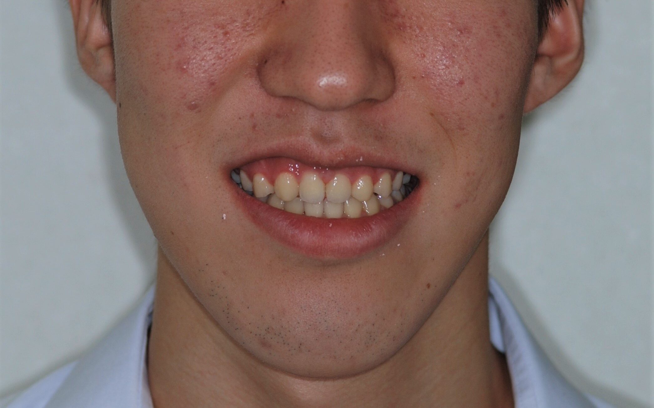 前歯の隙間の矯正治療後