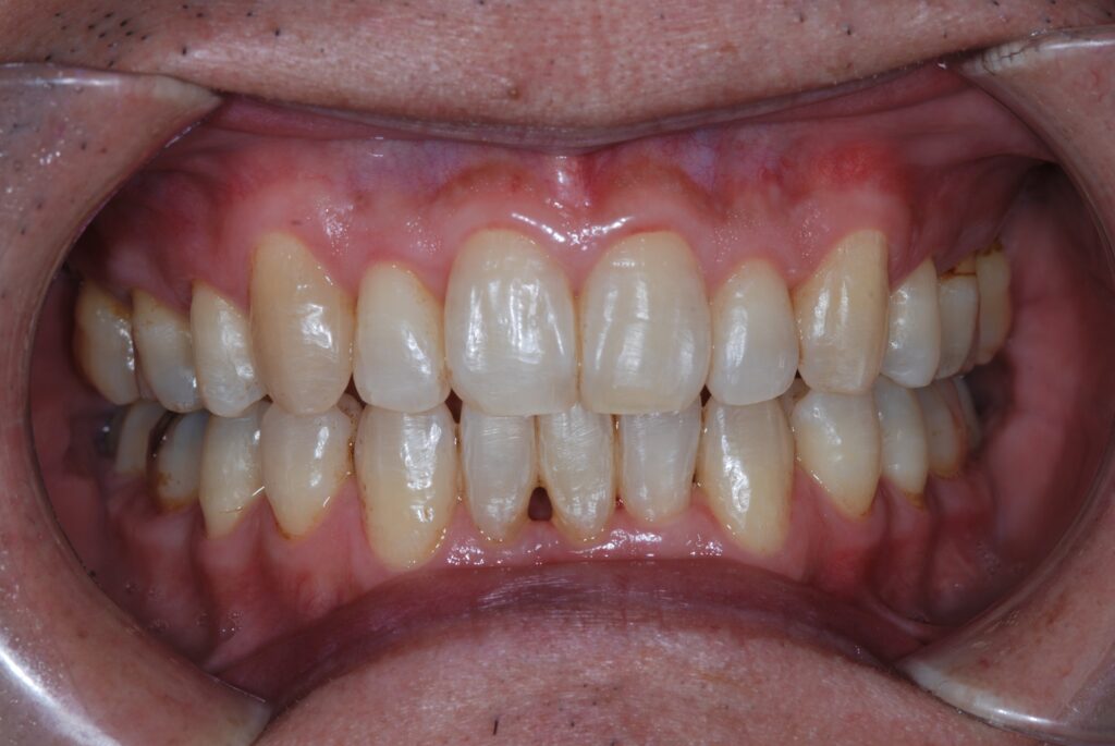 矯正治療でかみ合わせを治した後の前歯