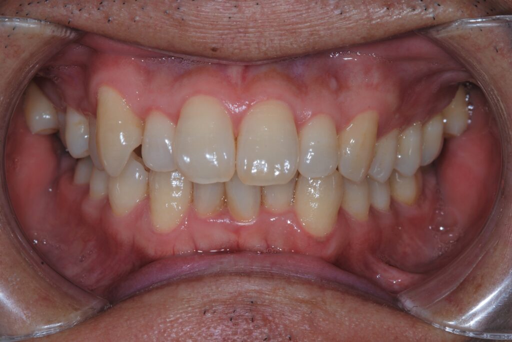 矯正治療でかみ合わせを治す前の前歯