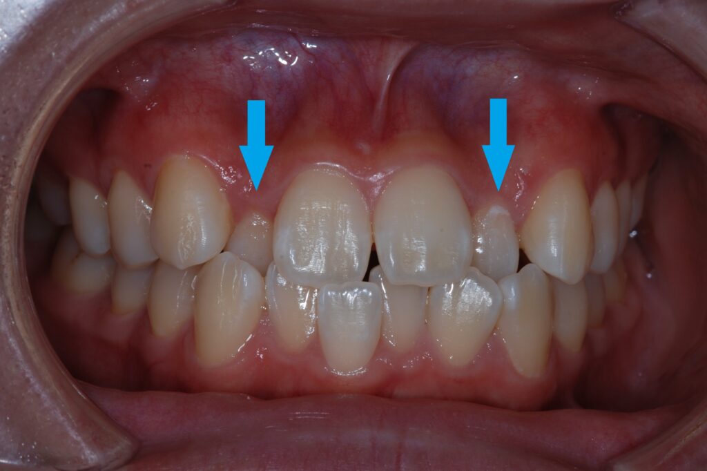 反対咬合 | 横浜矯正歯科 アーティスティック スマイル クリニック