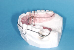 歯科矯正治療とタングクリブ