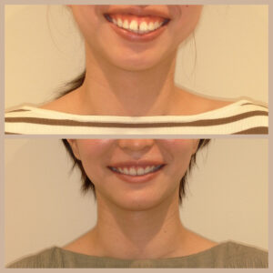 出っ歯の矯正治療例