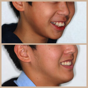 出っ歯と前歯のがたつきの矯正治療例