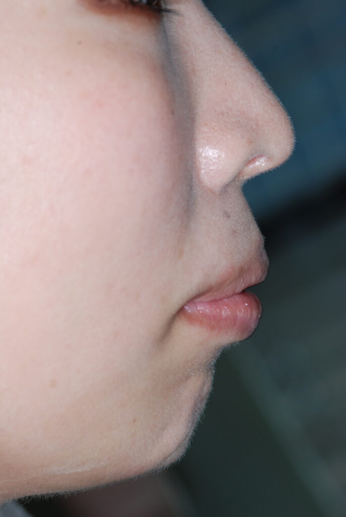 口ごぼの矯正治療前