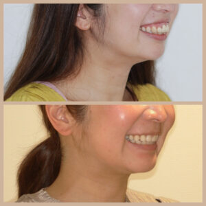 手術が必要だった出っ歯の矯正治療例