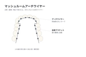舌側矯正で使うマッシュルームアーチ